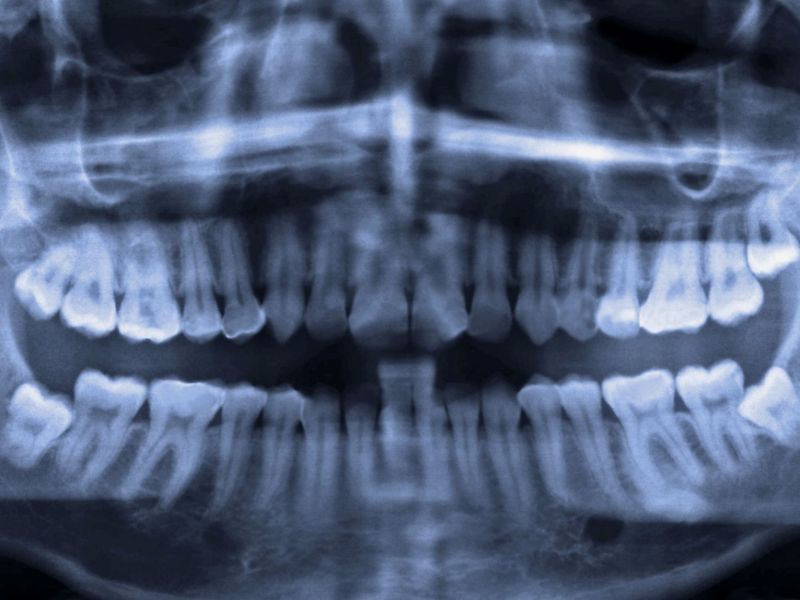 Röntgenaufnahmen mit Weisheitszähnen.